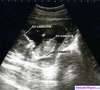 ecograf&iacute;a en 4D Karlo Iv&aacute;n con 29 semanas de gestaci&oacute;n